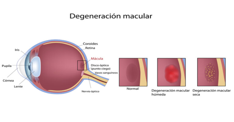 Membrana plástica para tratar la dmre