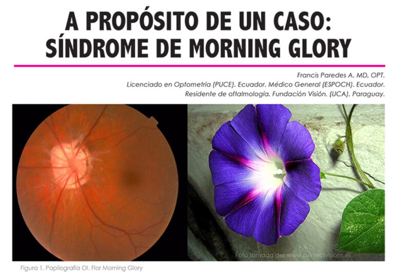 A PROPÓSITO DE UN CASO:  SÍNDROME DE MORNING GLORY