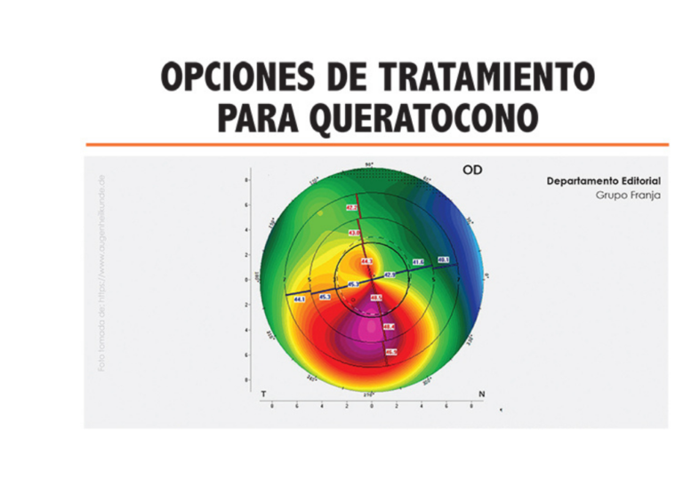 Opciones de tratamiento para queratocono