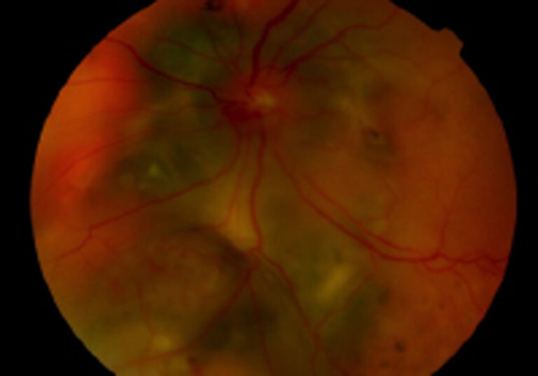 Autofluorescencia de retina por osteoma coroideo