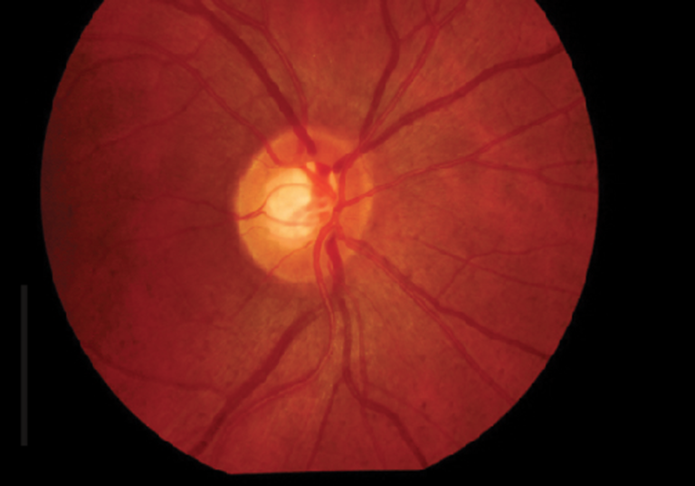 ENFERMEDADES SISTÉMICAS COMUNES EN LA NEUROPATÍA ÓPTICA GLAUCOMATOSA