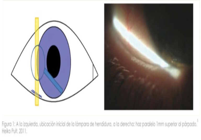 LIPCOF, INDICADOR DE OJO SECO