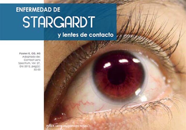 Enfermedad de Stargardt y lentes de contacto