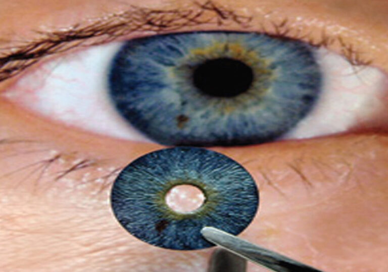 Iris de silicona para ojos postraumáticos