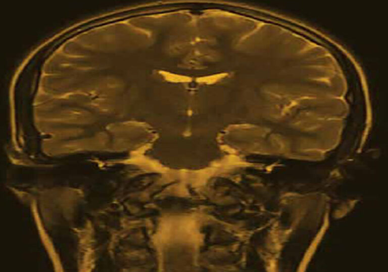 Repercusiones del síndrome de latigazo cervical