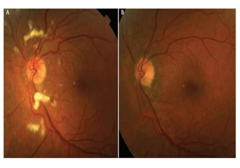 RETINOPATÍA POR RADIOTERAPIA