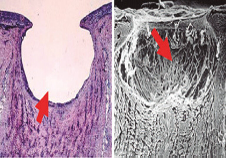 Neuropatía óptica glaucomatosa