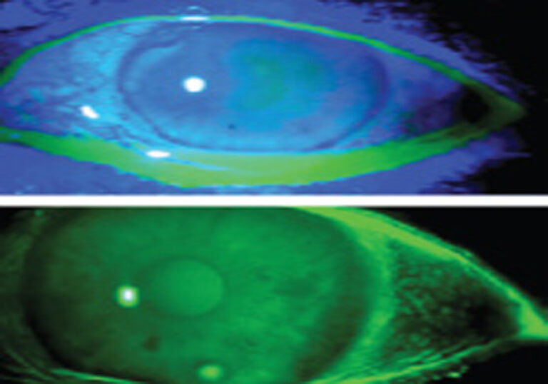 Trasplante de membrana amniótica en la reparación De la superficie ocular