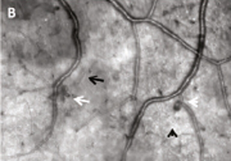 Óptica adaptativa detecta cambios tempranos en la retinopatía diabética