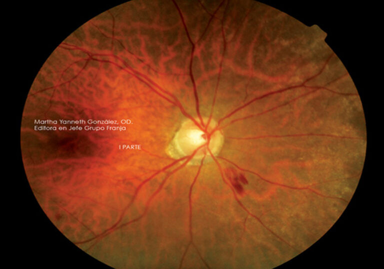 Retinopatía, cuidado primario ocular (parte I y II)