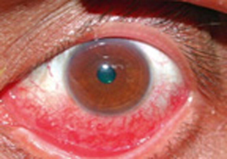 Conjuntivitis alérgica Tratamiento con alcaftadina