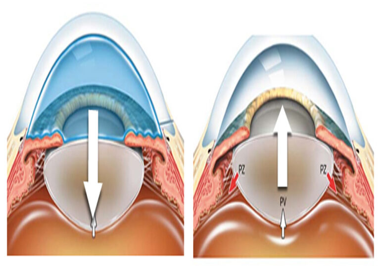 Capsulorrexis – creando el instrumento adecuado