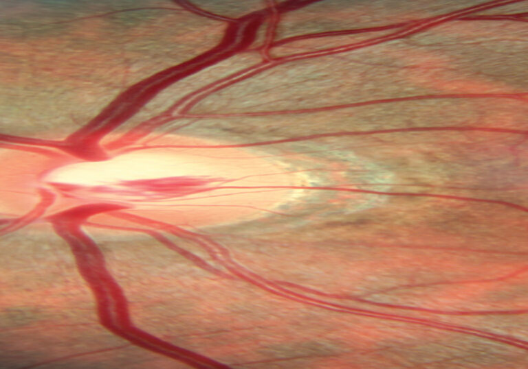 Glaucoma el concepto evoluciona permanentemente