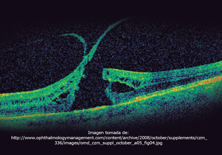 Nuevo sistema para clasificar la enfermedad vitreomacular