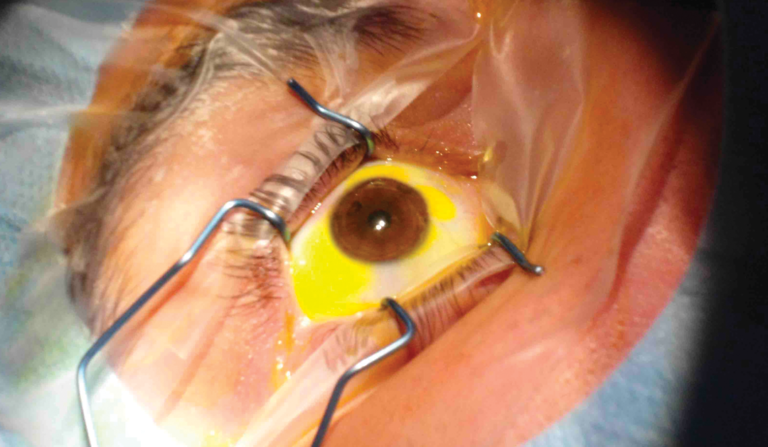 Cross linking de conjuntiva para reparar fuga de ampolla post cirugía de glaucoma