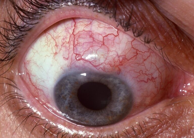 Análisis del astigmatismo inducido por la cirugía de glaucoma