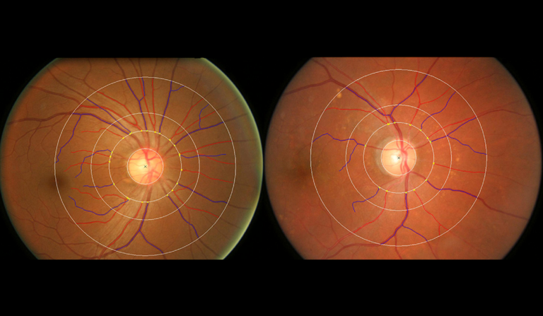 Aplicación de las dimensiones fractales en oftalmología