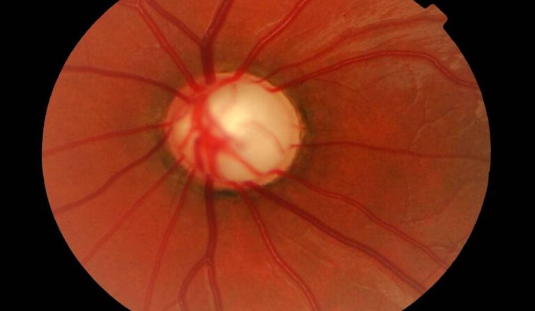 Puntos clave para el diagnóstico del paciente con glaucoma