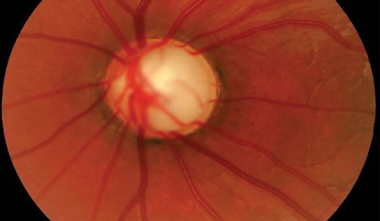 Relación entre presión arterial y glaucoma, aún un enigma