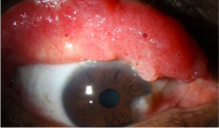 Compromiso de la superficie ocular por el virus del papiloma humano