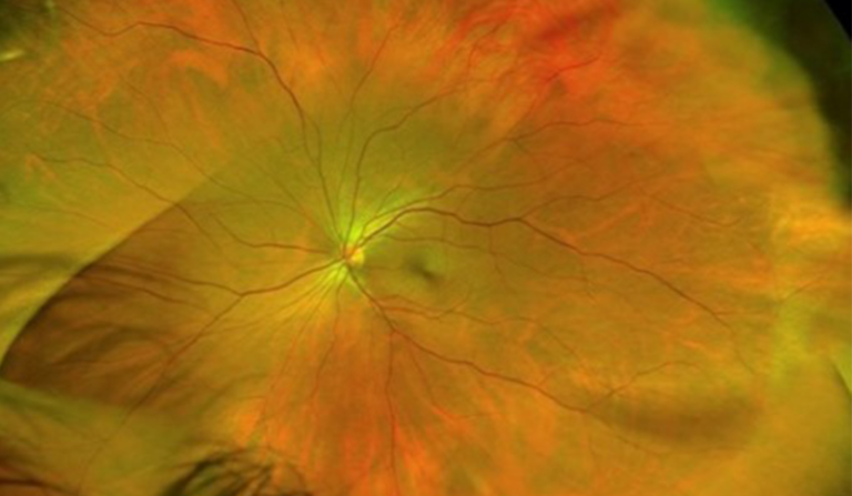 Imagenología de retina ultra gran campo: ventajas