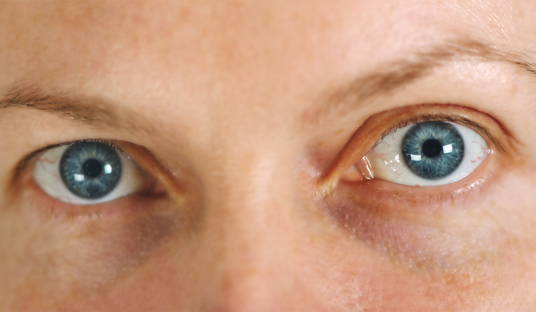 ¿Cómo abordar la enfermedad de superficie ocular en cirugía de catarata?