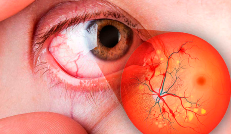 Medicamento para adelgazar y la enfermedad ocular diabética