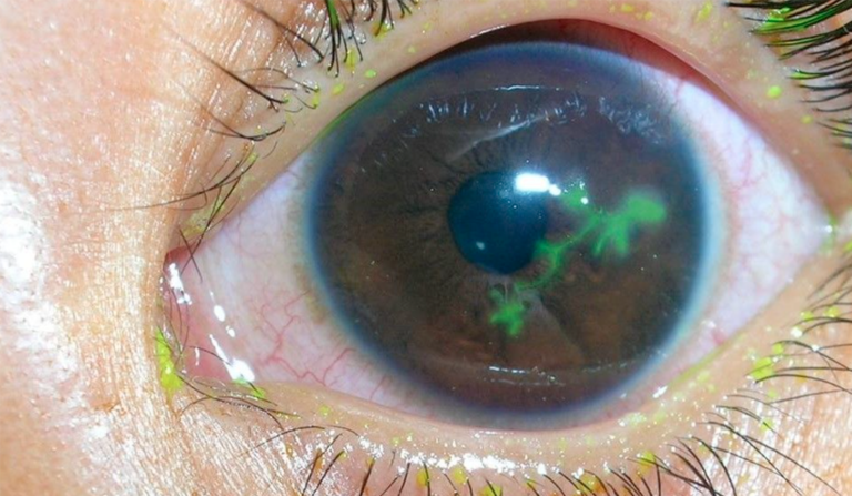 ¿Reactivación de queratitis herpética tras Cross-Linking corneal?