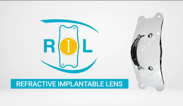 Lente Refractiva Implantable (RIL) de Appasamy