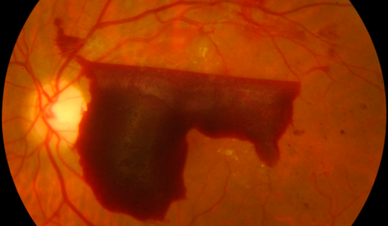 Láser de escaneo de patrones en el abordaje de patología retiniana