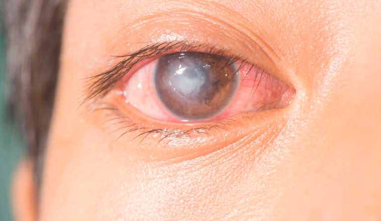 Queratoplastia tectónica, una opción urgente