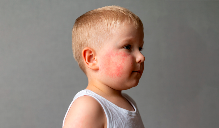 Dermatitis Atópica de Inicio Temprano Asociada con Mayor Riesgo de Uveítis Pediátrica