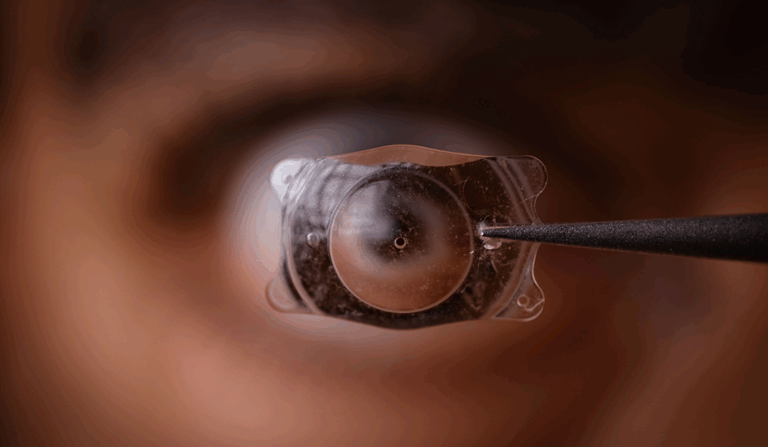 IA para el cálculo de LIO tras cirugía refractiva
