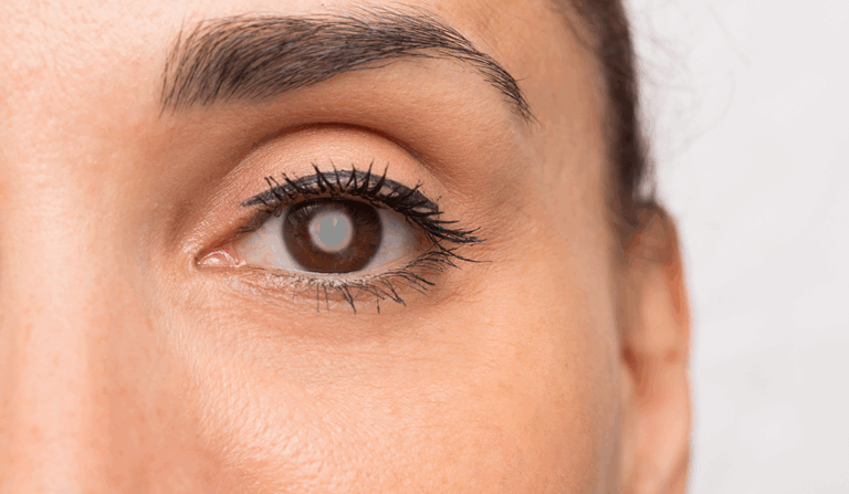 Manejo Integral del Paciente con Catarata y Glaucoma