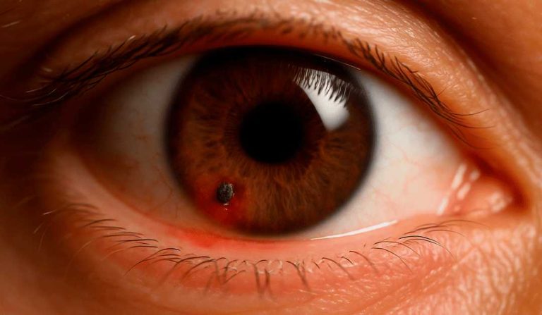 Cuerpos extraños superficiales e intraoculares: diagnóstico y manejo oportuno