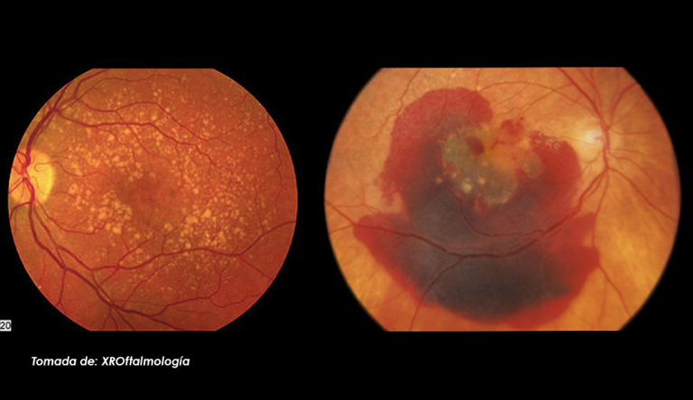 ¿Debe reconsiderarse la indicación de suplementos AREDS en pacientes con DMAE?