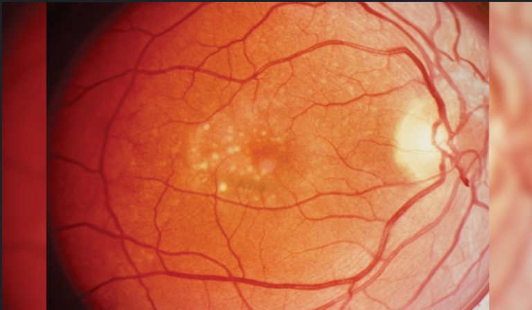 AREDS bajo revisión: nueva evidencia en atrofia geográfica