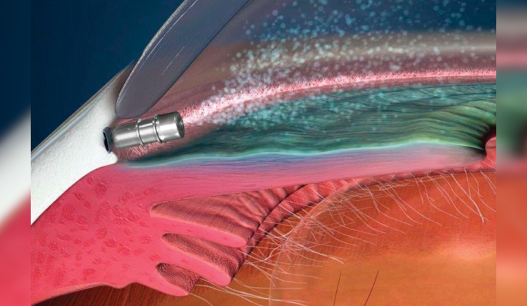 Sistemas de liberación sostenida de fármacos para glaucoma aprobados por la FDA