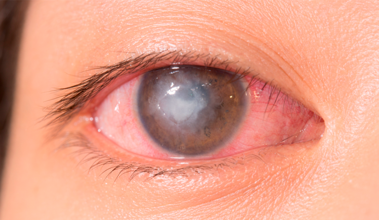 Uso de losartán tópico en secuelas de queratitis infecciosa