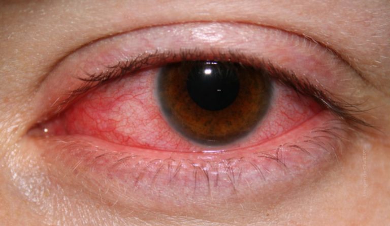 Raspado corneal, procedimiento clave en el diagnóstico temprano de la queratitis por Acanthamoeba
