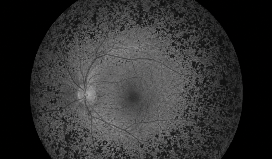 Grayscale retinal fundus image showing optic disc on the left, central macula, and branching retinal vessels.
