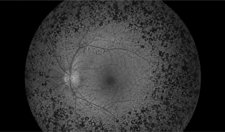 Grayscale retinal fundus image showing optic disc on the left, central macula, and branching retinal vessels.