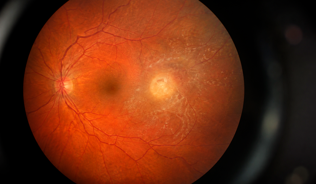 Color fundus photograph of the retina showing the optic disc on the left and a circular macular lesion near center surrounded by blood vessels.