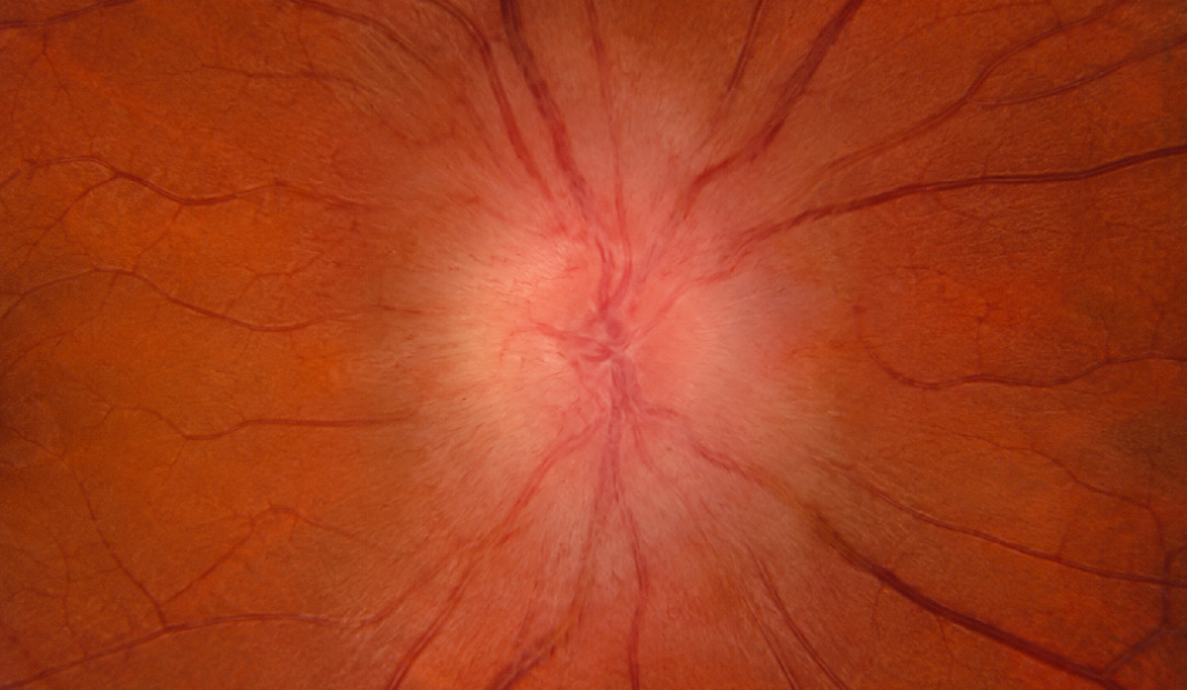 Close-up of a human retina focusing on the optic disc with radiating blood vessels and a reddish background.